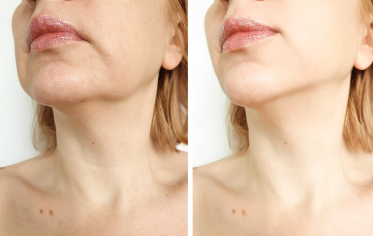 Sagging Skin Treatment for a Firm, Youthful, and Lifted Appearance Without Surgery