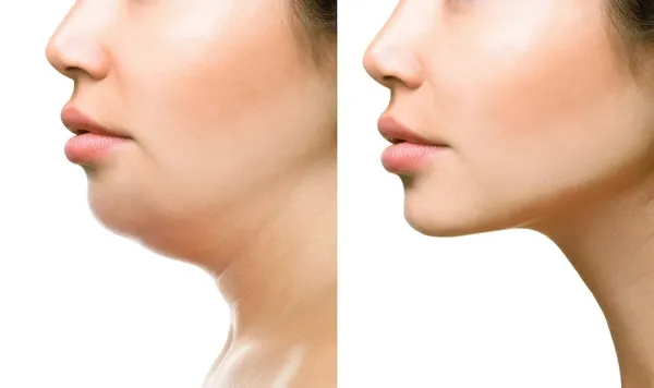 non-surgical jaw reduction