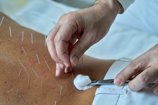 acupuncture dubai