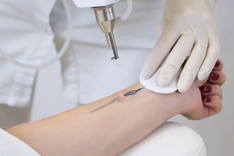 Neatcell Tattoo Removal Reviews: Debunking the Hype