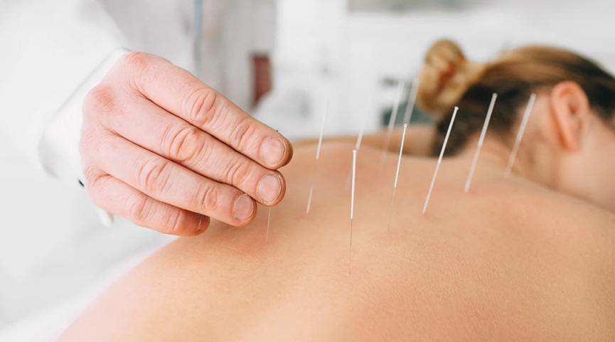 Acupuncture